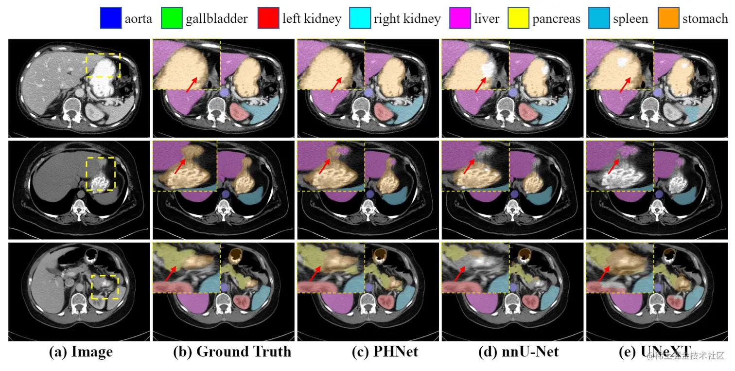 Synapse数据集上不同方法的定性可视化效果，为了更好地展示细节，显著改进的区域被放大