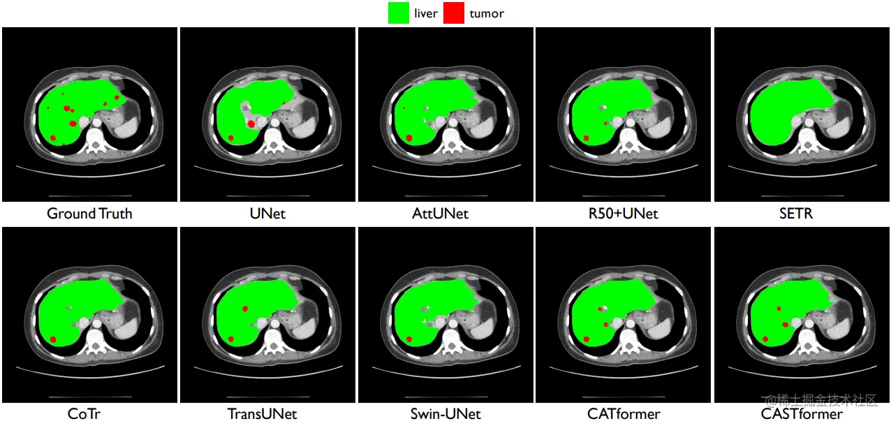 Visual comparisons with other methods on LiTS dataset