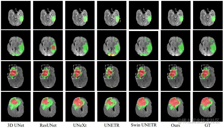 图 4：不同模型在 BraTS 2020 上的预测分割掩码