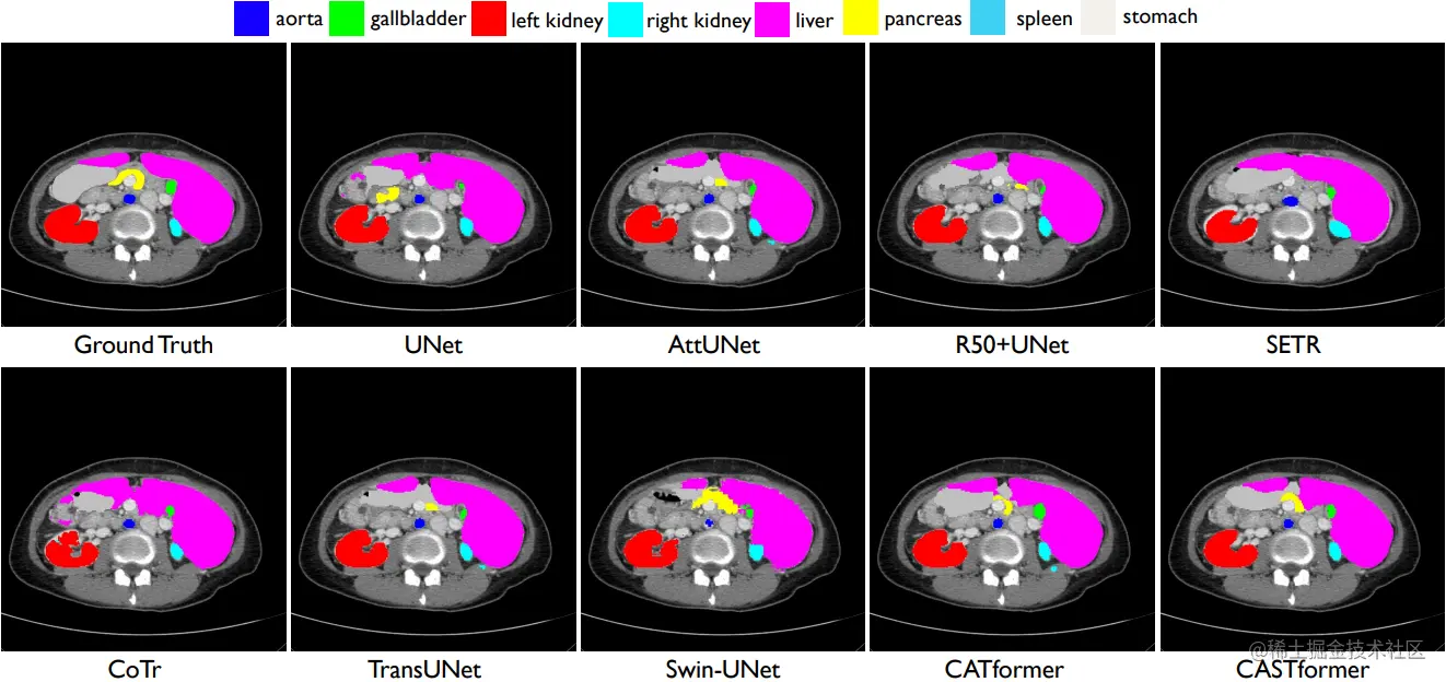Visual comparisons with other methods on Synapse dataset